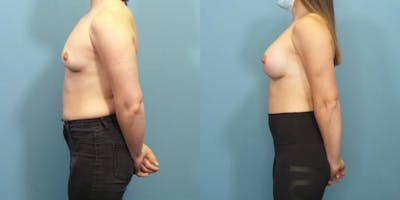 Breast Augmentation Before & After Gallery - Patient 113305 - Image 2