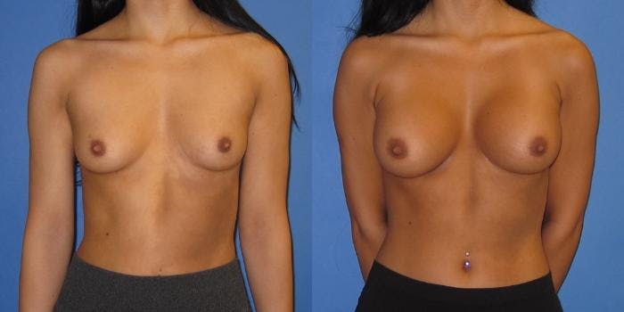 Breast Augmentation Before & After Gallery - Patient 233483 - Image 1