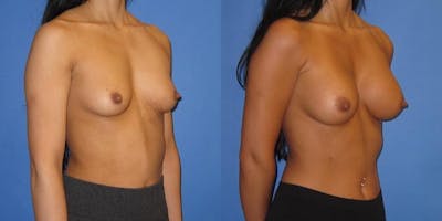 Breast Augmentation Before & After Gallery - Patient 233483 - Image 2