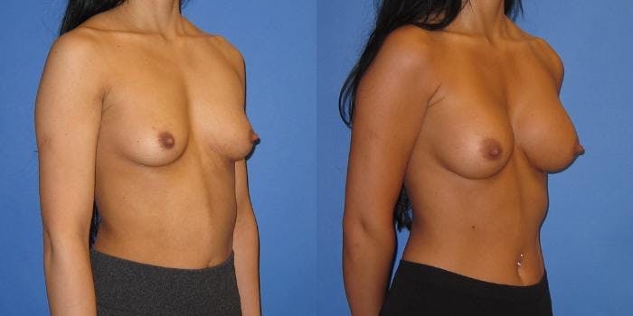 Breast Augmentation Before & After Gallery - Patient 233483 - Image 2