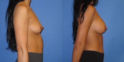 Breast Augmentation Before & After Gallery - Patient 233483 - Image 3