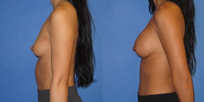 Breast Augmentation Before & After Gallery - Patient 233483 - Image 4