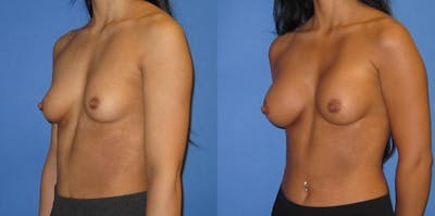 Breast Augmentation Before & After Gallery - Patient 233483 - Image 5