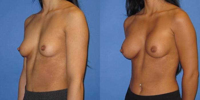 Breast Augmentation Before & After Gallery - Patient 233483 - Image 5
