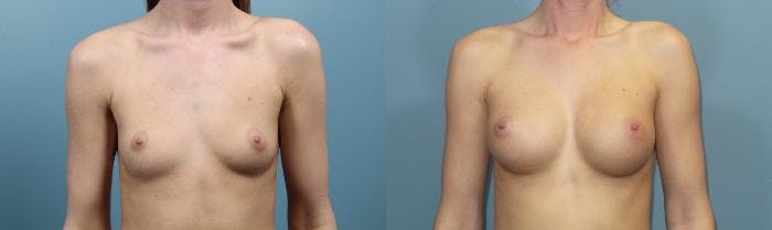 Breast Augmentation Before & After Gallery - Patient 176003 - Image 1