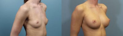 Breast Augmentation Before & After Gallery - Patient 176003 - Image 2