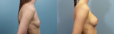 Breast Augmentation Before & After Gallery - Patient 176003 - Image 3