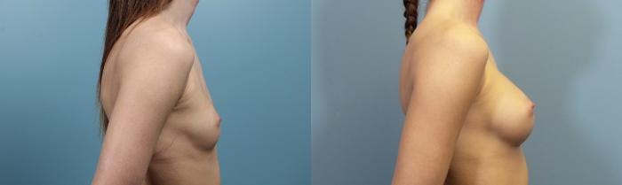 Breast Augmentation Before & After Gallery - Patient 176003 - Image 3