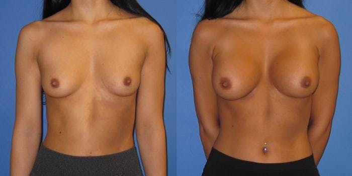 Breast Augmentation Before & After Gallery - Patient 428322 - Image 1