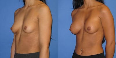 Breast Augmentation Before & After Gallery - Patient 428322 - Image 2