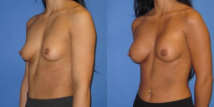 Breast Augmentation Before & After Gallery - Patient 428322 - Image 2
