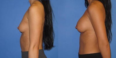 Breast Augmentation Before & After Gallery - Patient 428322 - Image 3