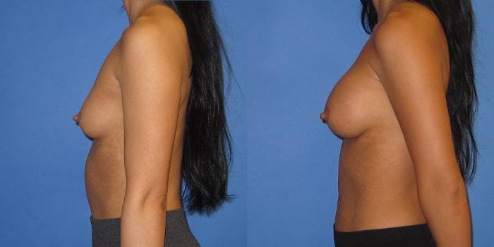 Breast Augmentation Before & After Gallery - Patient 428322 - Image 3