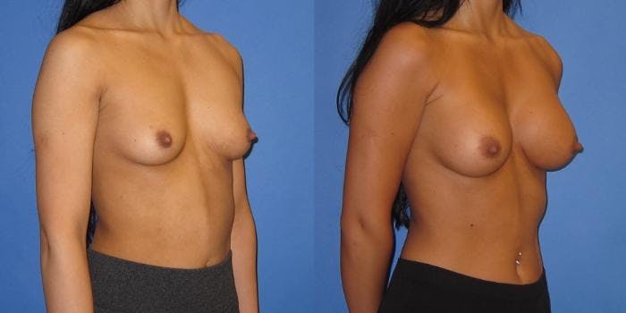 Breast Augmentation Before & After Gallery - Patient 428322 - Image 4
