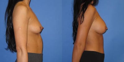 Breast Augmentation Before & After Gallery - Patient 428322 - Image 5