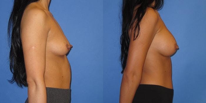 Breast Augmentation Before & After Gallery - Patient 428322 - Image 5