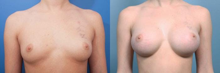 Breast Augmentation Before & After Gallery - Patient 155634 - Image 1