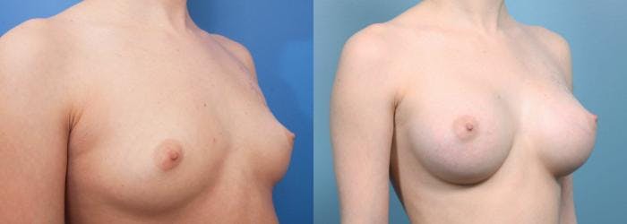 Breast Augmentation Before & After Gallery - Patient 155634 - Image 2