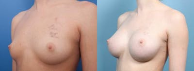 Breast Augmentation Before & After Gallery - Patient 155634 - Image 3
