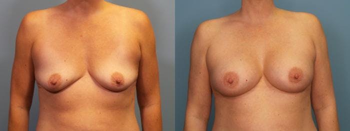 Breast Augmentation Before & After Gallery - Patient 290708 - Image 1