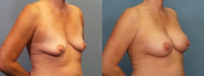 Breast Augmentation Before & After Gallery - Patient 290708 - Image 2