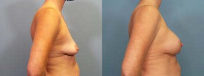 Breast Augmentation Before & After Gallery - Patient 290708 - Image 3
