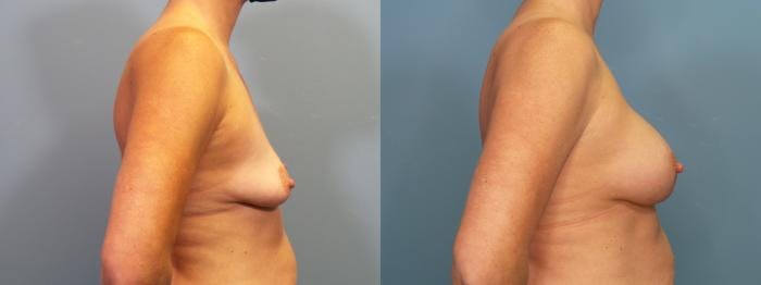 Breast Augmentation Before & After Gallery - Patient 290708 - Image 3