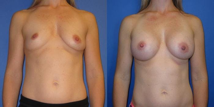 Breast Augmentation Before & After Gallery - Patient 292249 - Image 1