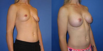 Breast Augmentation Before & After Gallery - Patient 292249 - Image 2