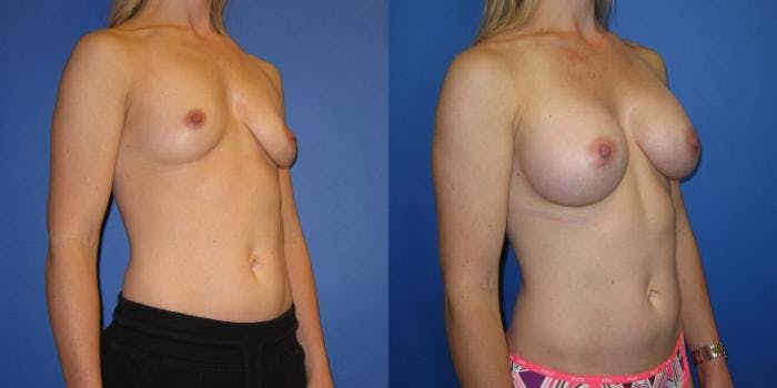 Breast Augmentation Before & After Gallery - Patient 292249 - Image 2