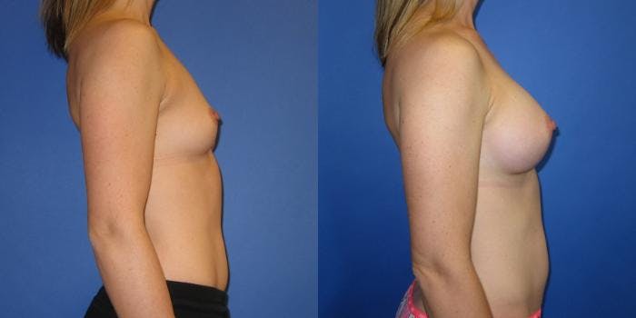 Breast Augmentation Before & After Gallery - Patient 292249 - Image 3