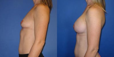 Breast Augmentation Before & After Gallery - Patient 292249 - Image 4