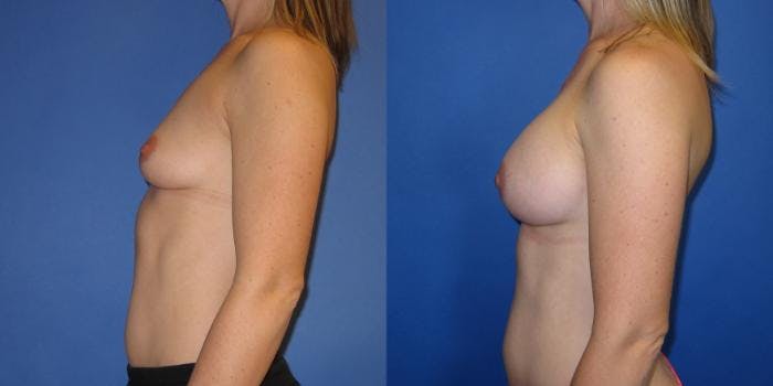 Breast Augmentation Before & After Gallery - Patient 292249 - Image 4
