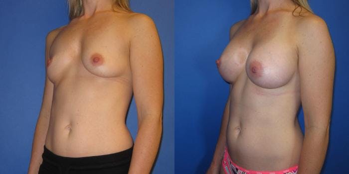Breast Augmentation Before & After Gallery - Patient 292249 - Image 5