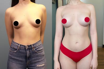 Breast Augmentation Before & After Gallery - Patient 377658 - Image 1