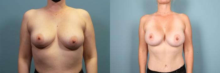 Breast Augmentation Before & After Gallery - Patient 572357 - Image 1