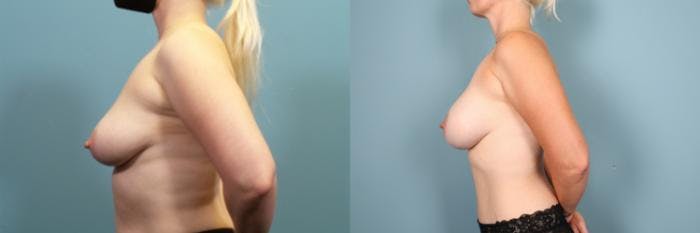 Breast Augmentation Before & After Gallery - Patient 572357 - Image 2