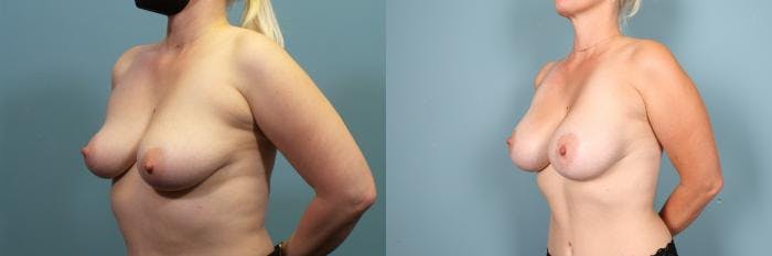Breast Augmentation Before & After Gallery - Patient 572357 - Image 3