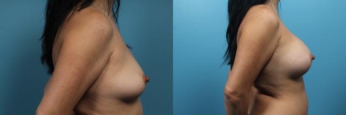 Breast Augmentation Before & After Gallery - Patient 329391 - Image 3