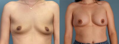 Breast Augmentation Before & After Gallery - Patient 959393 - Image 1
