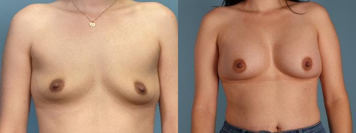 Breast Augmentation Before & After Gallery - Patient 959393 - Image 1