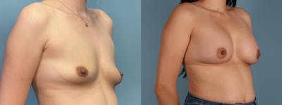 Breast Augmentation Before & After Gallery - Patient 959393 - Image 2
