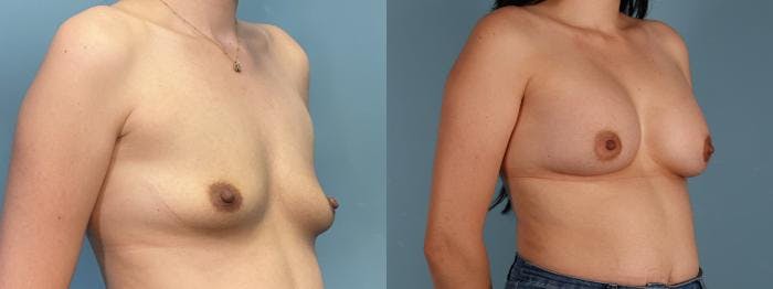 Breast Augmentation Before & After Gallery - Patient 959393 - Image 2