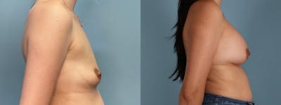 Breast Augmentation Before & After Gallery - Patient 959393 - Image 3