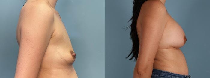 Breast Augmentation Before & After Gallery - Patient 959393 - Image 3