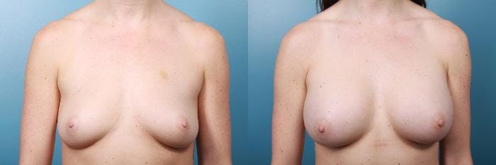 Breast Augmentation Before & After Gallery - Patient 377908 - Image 1