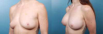 Breast Augmentation Before & After Gallery - Patient 377908 - Image 2