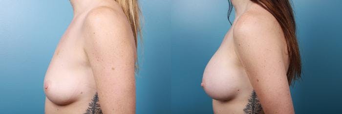 Breast Augmentation Before & After Gallery - Patient 377908 - Image 3