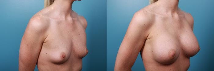 Breast Augmentation Before & After Gallery - Patient 223871 - Image 1