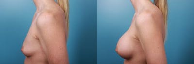 Breast Augmentation Before & After Gallery - Patient 223871 - Image 2